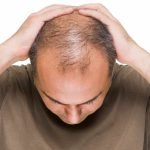 Haartransplantation und Sie