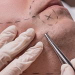 Before and After Beard and Mustache Transplantation