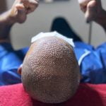 Tension in the Head After Hair Transplantation