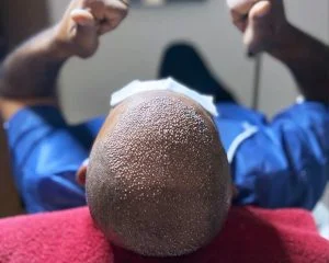 Tension in the Head After Hair Transplantation