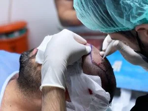 ¿Qué es el Trasplante Capilar?