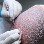 Dinge, die vor und nach der Haartransplantation zu beachten sind