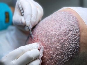 Dinge, die vor und nach der Haartransplantation zu beachten sind