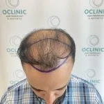 Forehead Hair Transplant