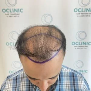 Forehead Hair Transplant