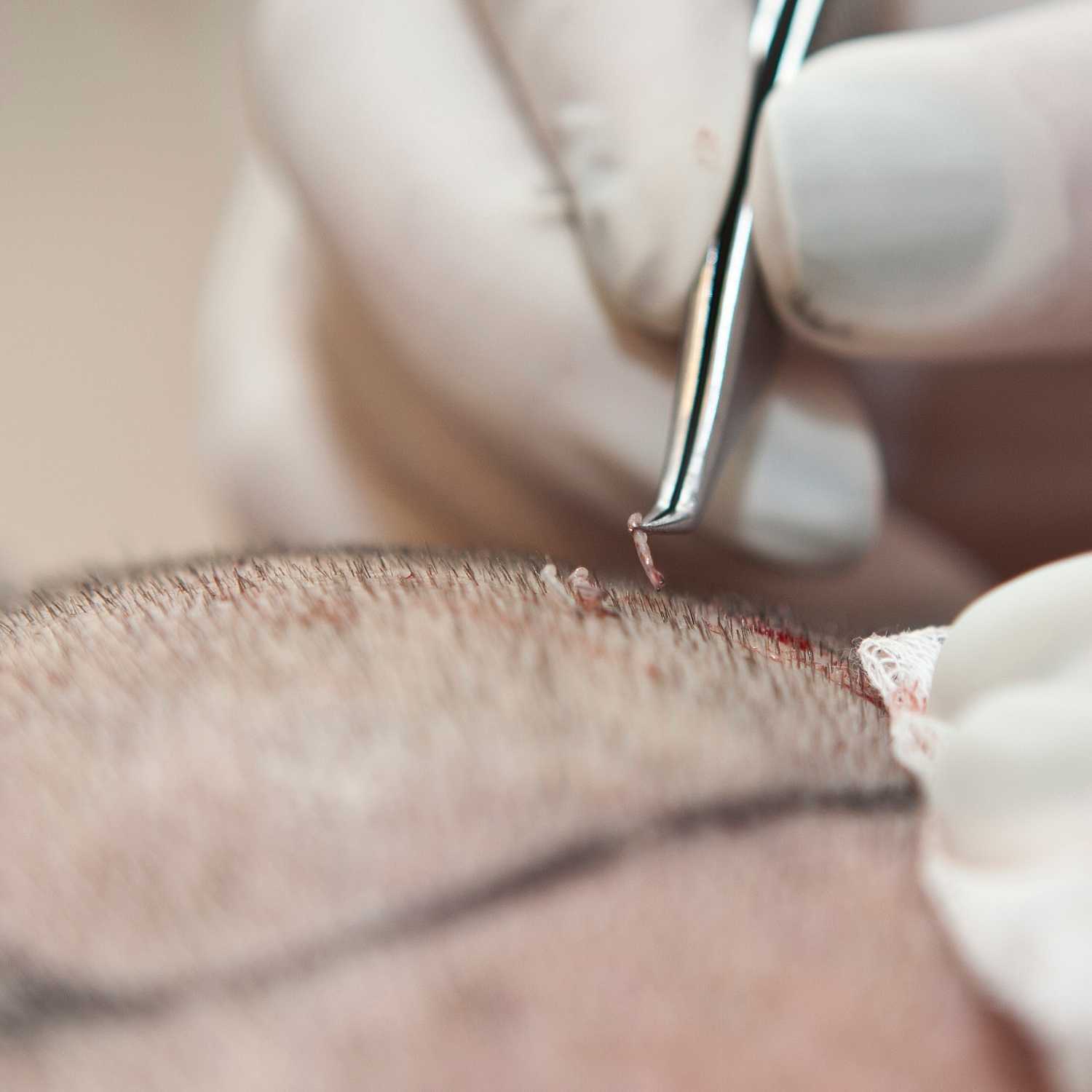 How Many Grafts Should a Hair Transplant Be? - O Clinic Hair Transplant  Hair Transplant & Aesthetic