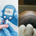 Can Diabetics Have Hair Transplantation?