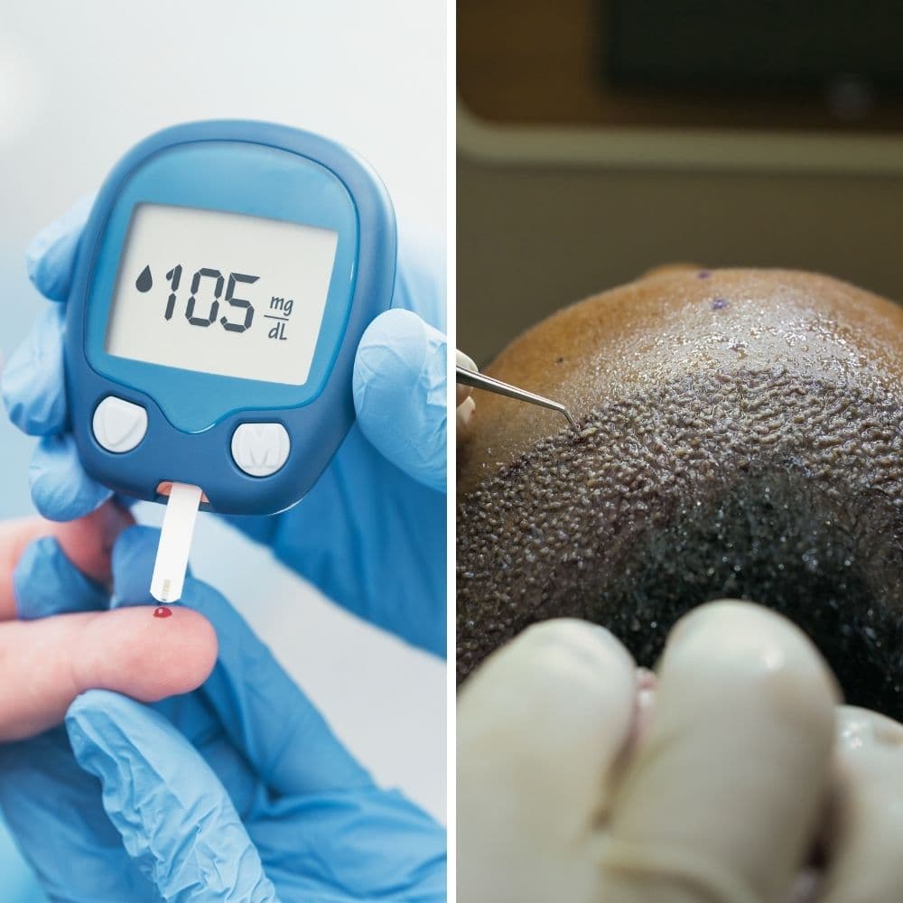 Can Diabetics Have Hair Transplantation? O Clinic Hair Transplant